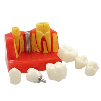Dantų Implantai Keturis Kartus Mokymo Dantų Modelis 4 Kartus Dantų Dervos Kvarco Gumos Dantų Modelio Stomatologas Mokymo Patologijos Modelis